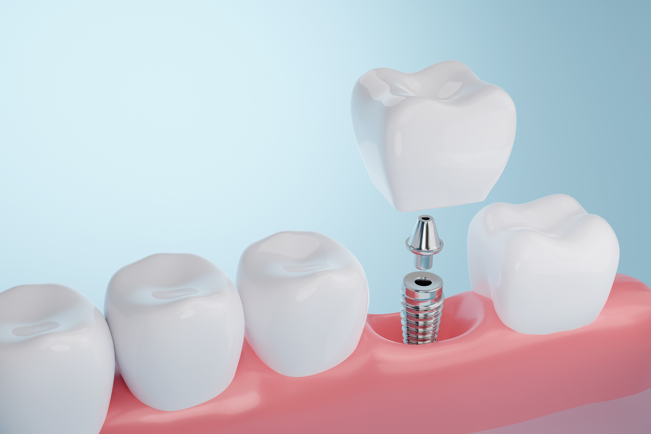 implant dentaire hannut